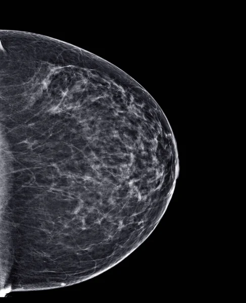X-ray Digital Mammogram or mammography of both side breast Standard views are bilateral craniocaudal (CC)   for  screening Breast cancer and evidence of malignancy .
