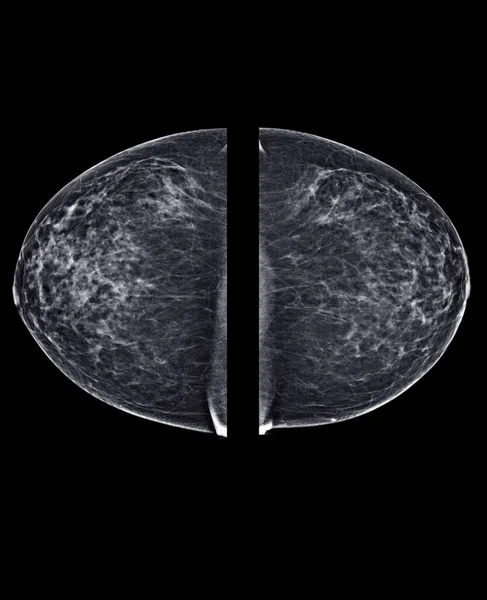 X-ray Digital Mammogram or mammography of both side breast Standard views are bilateral craniocaudal (CC)   for  screening Breast cancer and evidence of malignancy .