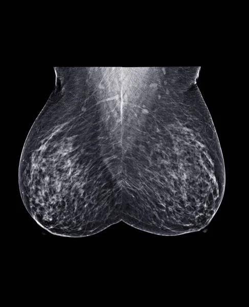 Ray Digital Mammogram Mammografie Van Beide Zijkant Borst Standaard Weergaven — Stockfoto