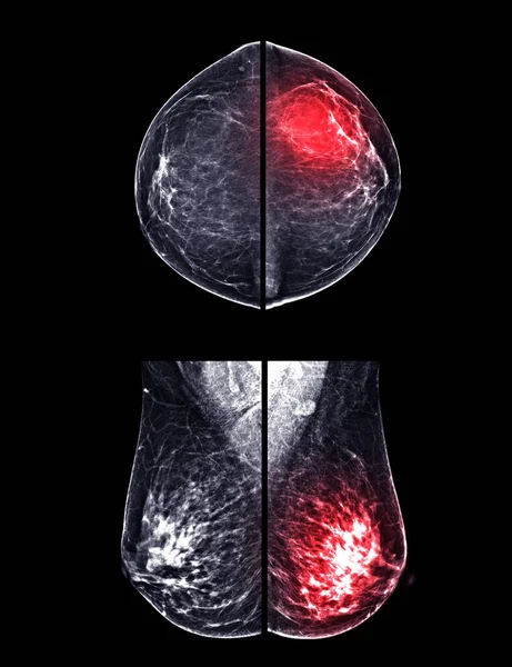 X-ray Digital Mammogram or mammography of both side breast CC view and MLO  for  screening Breast cancer and evidence of malignancy .
