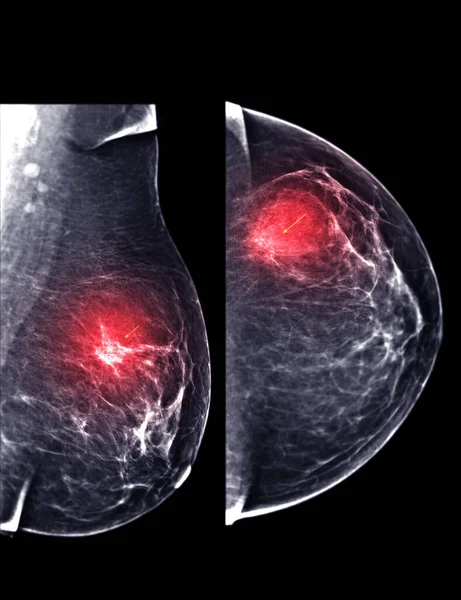 X线数字乳腺造影或双侧乳腺癌和Mlo检查乳腺癌和恶性肿瘤的证据 — 图库照片