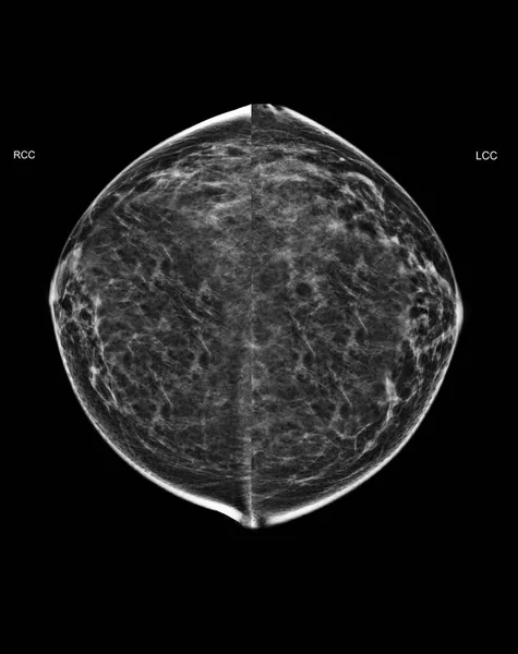 X-ray Digital Mammogram or mammography of both side breast Standard views are bilateral craniocaudal (CC)   for  screening Breast cancer and evidence of malignancy .