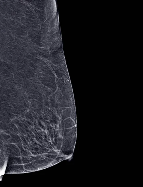 Rtg Cyfrowy Mammografia Lub Mammografia Obu Bocznych Piersi Standardowe Widoki — Zdjęcie stockowe