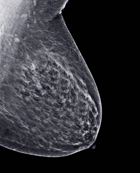 Röntgen Digitalt Mammogram Eller Mammografi Båda Sidor Bröst Standardvyer Mediolaterala — Stockfoto