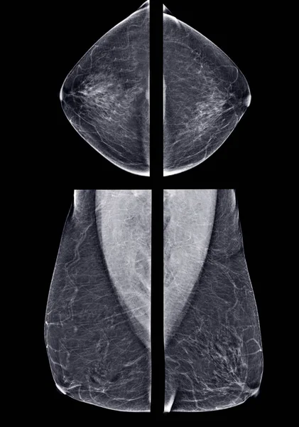 Ray Digitális Mammográfia Vagy Mammográfia Mindkét Oldalon Emlő Nézet Mlo — Stock Fotó