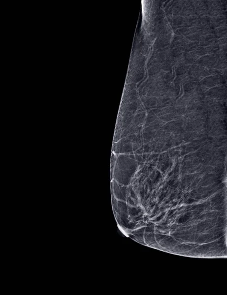 Ray Digital Mammogram Mammografie Van Beide Zijkant Borst Standaard Weergaven — Stockfoto