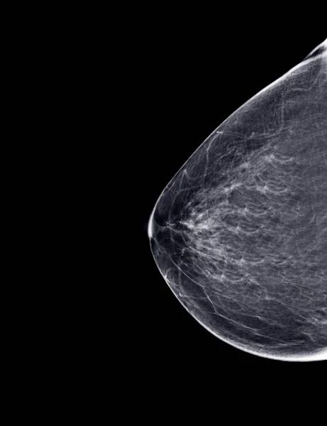 Radiografía Mamografía Digital Mamografía Ambas Mamas Laterales Las Vistas Estándar —  Fotos de Stock