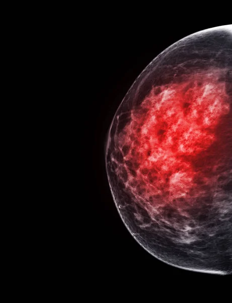 双侧乳腺X线平片或乳腺X线平片检查标准意见是检查乳腺癌的双侧颅内听诊 和恶性肿瘤的证据 — 图库照片
