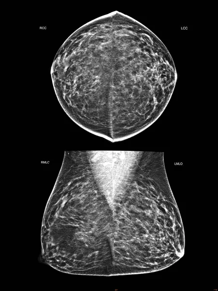 X-ray Digital Mammogram or mammography of both side breast Standard views are bilateral craniocaudal (CC)   for  screening Breast cancer and evidence of malignancy .