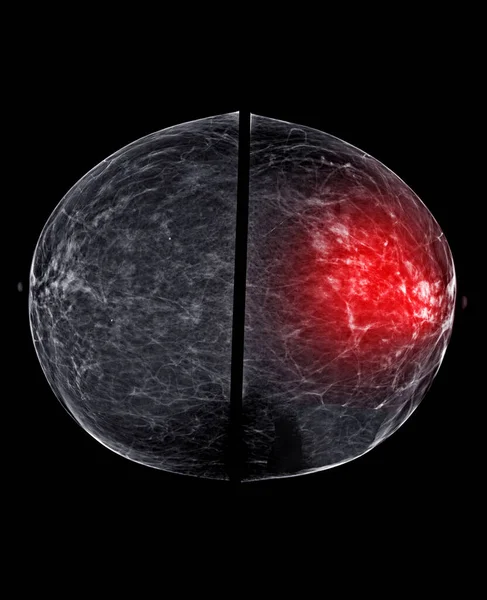 双侧乳腺X线平片或乳腺X线平片检查标准意见是检查乳腺癌的双侧颅内听诊 和恶性肿瘤的证据 — 图库照片