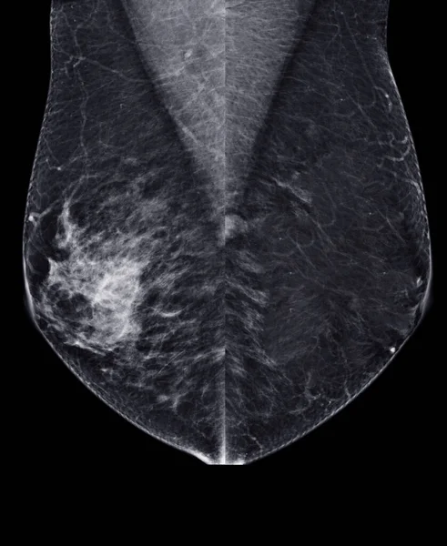 Ray Digital Mammogram Ray Digital Mammography 관점은 유방암 종양의 증거를 — 스톡 사진