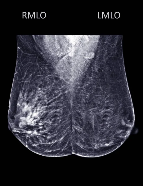X-ray Digital Mammogram or mammography of both side breast Standard views are  mediolateral oblique (MLO) views  for  screening Breast cancer and evidence of malignancy .