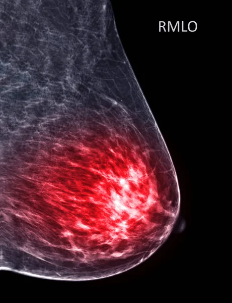 X线数字乳腺X线或双侧乳房X线X线乳腺X线平片或乳房X线平片检查是检查乳腺癌的中侧斜 Mlo 观点和恶性肿瘤的证据 — 图库照片
