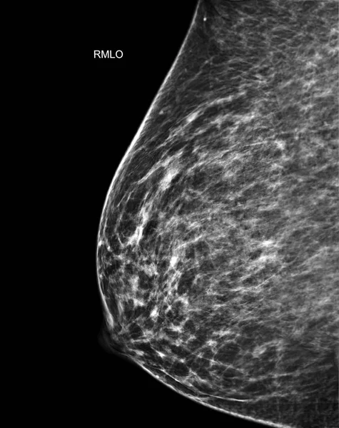 X-ray Digital Mammogram or mammography of both side breast Standard views are  mediolateral oblique (MLO) views  for  screening Breast cancer and evidence of malignancy .