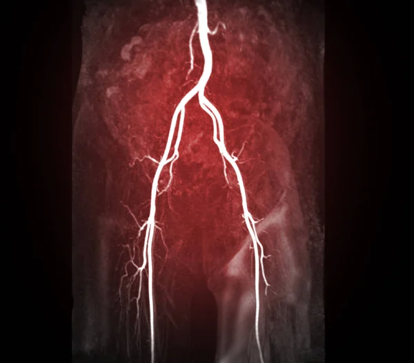 Mra Femoral Artery Mip View — Stock Photo, Image