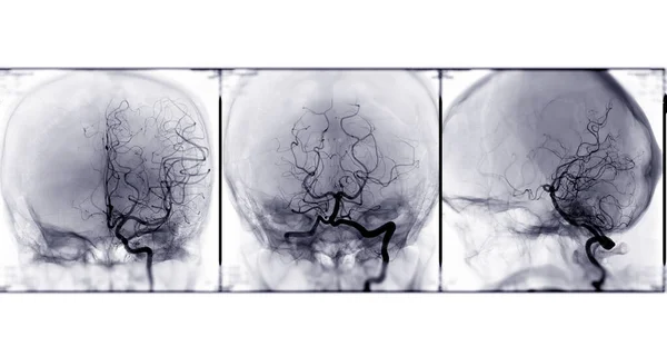 Colección Angiografía Cerebral Representación Mostrando Arteria Cerebral — Foto de Stock