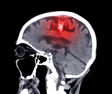 CT scan of the brain sagittal view  for diagnosis brain tumor,stroke diseases and vascular diseases. clipart