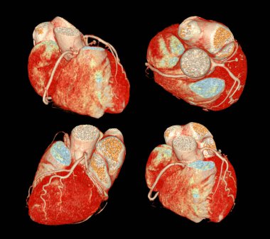 Koroner arter hastalıklarının önlenmesi ve taranması için CT 3D veya CTA koroner arteri.