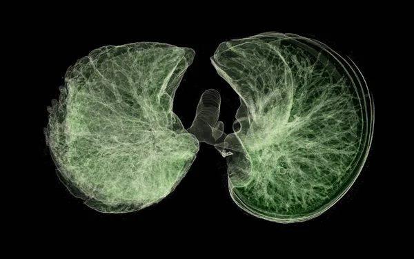 Chest Або Lung Рендеринг Зображення Діагностики Туберкульозу Туберкульозу Covid — стокове фото
