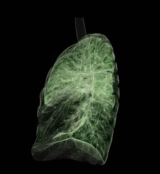 Hrudník Nebo Plicní Vykreslování Obraz Pro Diagnózu Tbc Tuberkulózy Covid — Stock fotografie