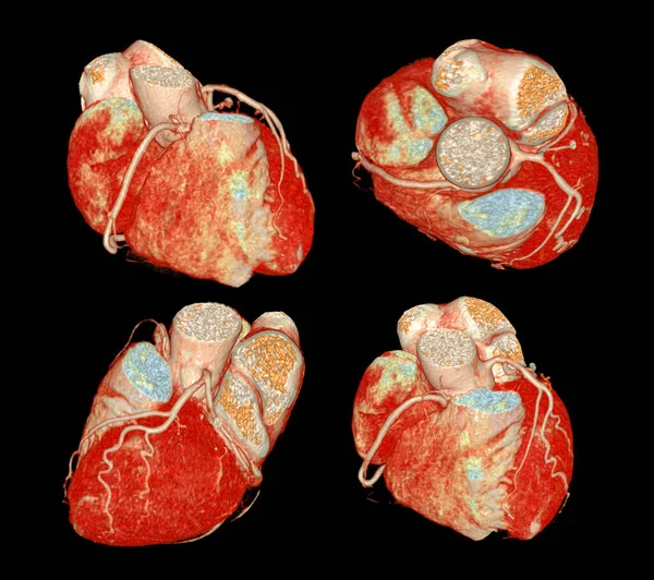 Artéria Coronária Cardíaca Cta Para Prevenção Rastreamento Doenças Arteriais Coronárias — Fotografia de Stock