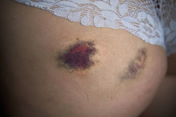 Düştükten Sonra Ciltte Yaralanma Bir Kadının Kalçasında Hematom — Stok fotoğraf