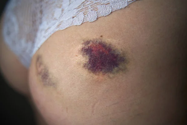 女人屁股上的大瘀伤秋季后臀部血肿的闭合 皮疹运动后的轻微伤害 表现为身体上皮肤变色的肿块 — 图库照片