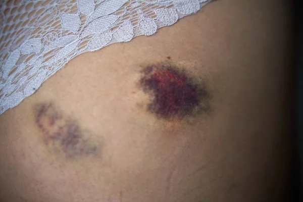 Large Bruise Woman Bum Close Hematoma Buttock Fall Minor Injury — Stok fotoğraf