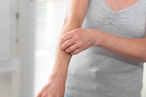 Een Vrouw Die Jeukt Aan Haar Arm Krabt Allergische Symptomen — Stockfoto