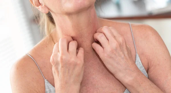 Mulher Com Comichão Coçando Pescoço Sintomas Alérgicos — Fotografia de Stock