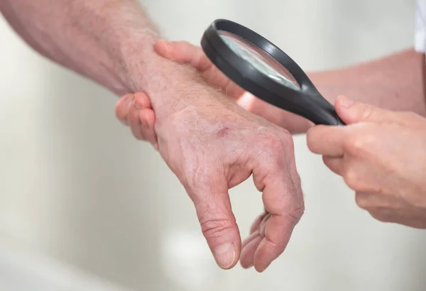 Dermatolog Undersöka Huden Patientens Hand Med Förstoringsglas — Stockfoto