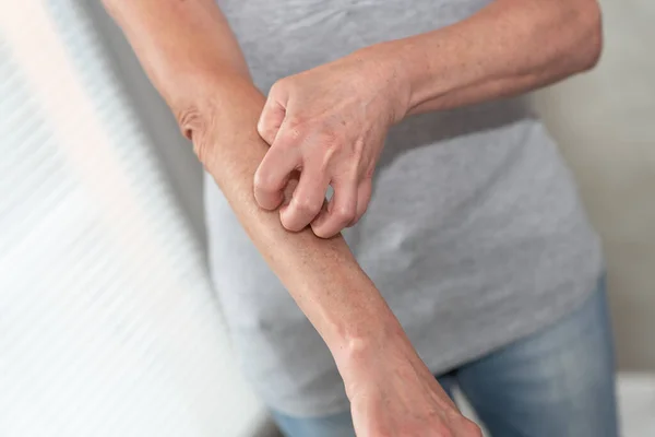 Woman Having Itchy Scratching Her Arm Allergy Symptoms — Stock Photo, Image