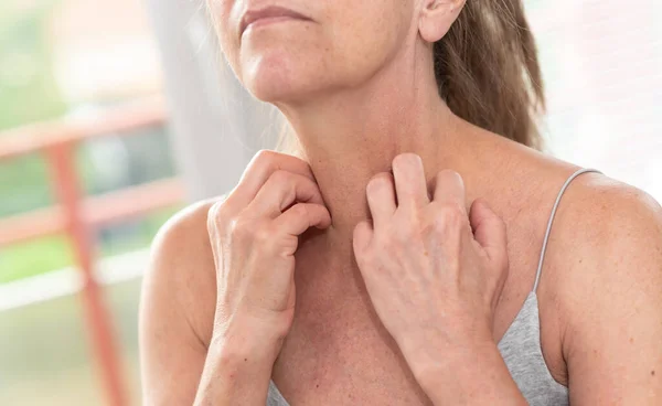 Een Vrouw Met Jeuk Krassen Haar Nek Allergische Symptomen — Stockfoto