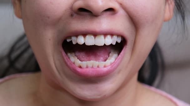 Asian Woman Smiles Revealing White Tooth Spot Fluorosis Female Teeth — стоковое видео