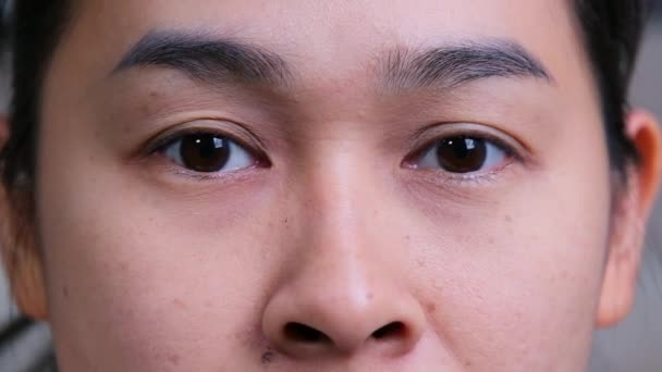 Asyalı Bir Kadın Gözlerini Ovuyor Kaşınıyor Acı Çekiyor Skleranın Hava — Stok video
