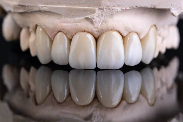 Assistência Médica Dentária Zircônio Cerâmico Versão Final Close Coroas Cerâmica — Fotografia de Stock