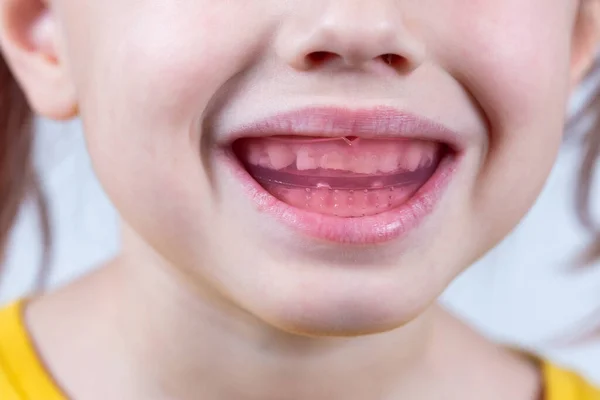 Sechsjährige Kaukasierin Zeigt Myofunktionstrainerin Zahntariner Wird Hergestellt Wachsende Zähne Auszugleichen Stockbild