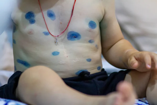 Suçiçeği virüsü. Vücudunda kızarıklık ve kabarcıklar var. Varicella zoster belirtileri için tedavi kavramı
