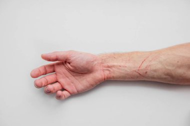 İzole edilmiş beyaz bir arka planda kuduz bir kedi tarafından tırmalanmış bir adam yatıyor. Tıbbi bakım, hidrojen peroksit tedavisi yaralar, çizikler, hayvan ısırıkları. Hayvan saldırısı. Kapat, boşluğu kopyala