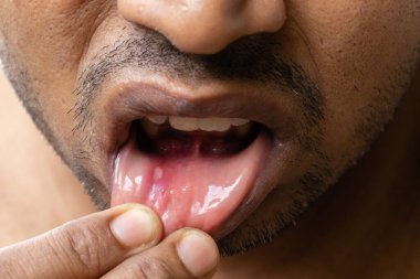 Close up of mouth ulcer of an Indian male clipart