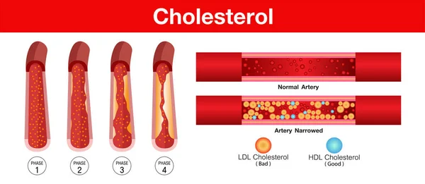 Colesterol Arteria Riesgo Para Salud Diseño Vectores — Vector de stock