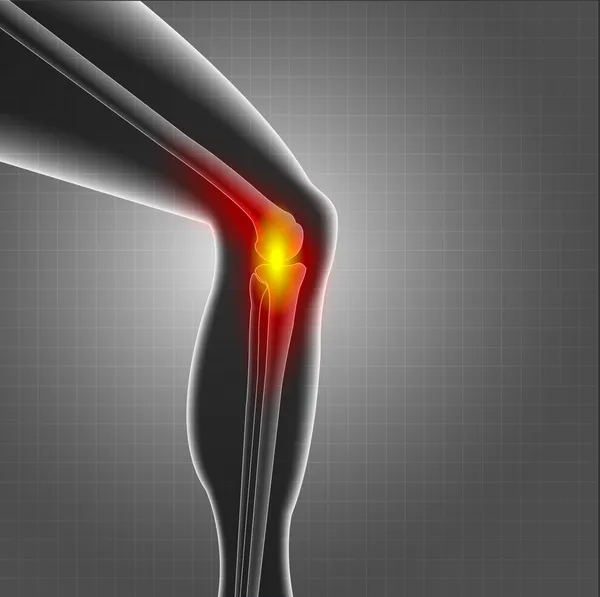 Dolor de rodilla — Vector de stock