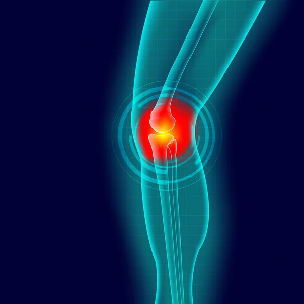 Kneee 痛み — ストック写真