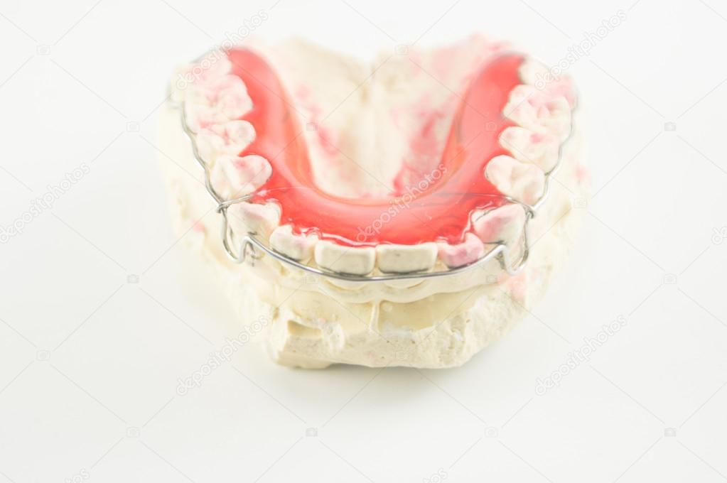 Dental brace and retainer on white background.