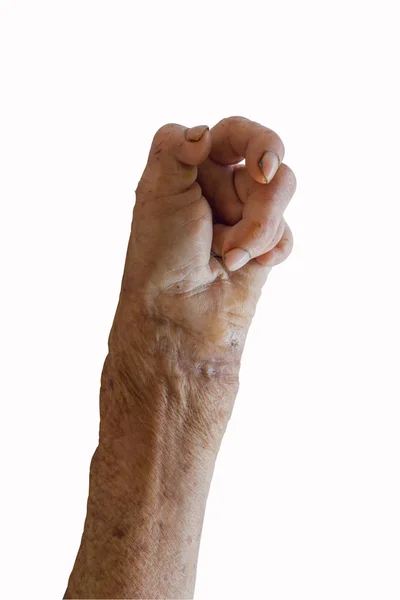 Left hand of a leprosy — Stock Photo, Image