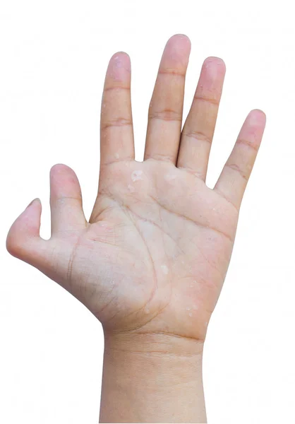 Six-fingers hand — Stock Photo, Image