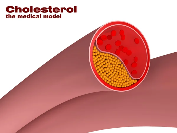 Model van cholesterol in slagader — Stockfoto