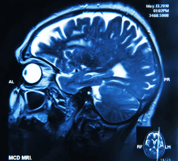 Beyin üzerinde x-ray — Stok fotoğraf