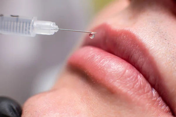 Nahaufnahme eines Tropfens eines Medikaments, der von einer Spritzennadel auf die Lippen eines männlichen Patienten einer Kosmetikpraxis fällt. Verjüngungskur, Injektionen von Hyaluronsäure zur Befeuchtung der Lippen — Stockfoto
