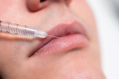 Kozmetoloji bürosundaki erkek bir hastanın dudaklarına şırıngadan düşen bir ilacın damlasına yaklaş. Yenilenme prosedürü, dudakları nemlendirmek için hiyalüronik asit enjeksiyonu.